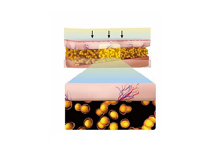 Damaged fat cells are broken down and cleared through the natural body process (apoptosis).