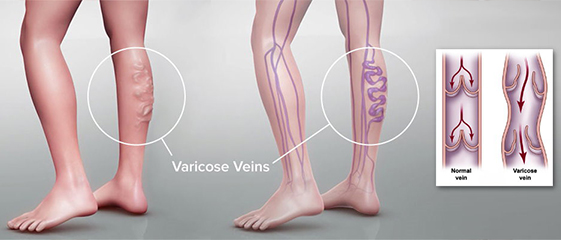 Endovenous Laser Treatment for Varicose Veins