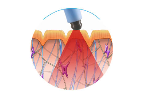 Volumetric Heating disrupts old collagen fibers and initiates the process of new collagen formation