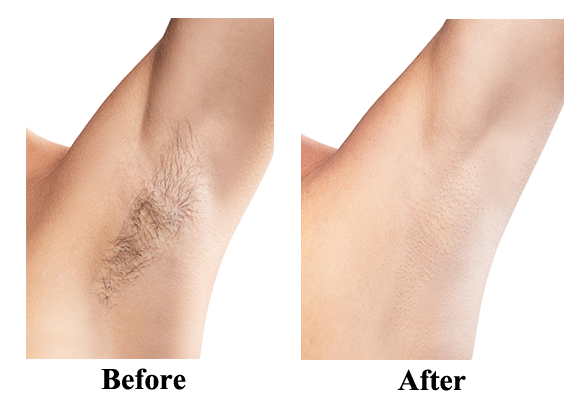 Armpit Laser Hair Removal