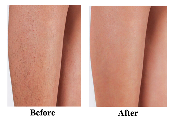 Leg Laser Hair Removal