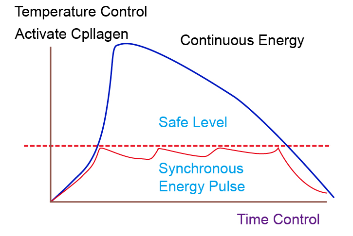 The most advanced technology of double pulse energy produces a high repetition rate (100kHZ).