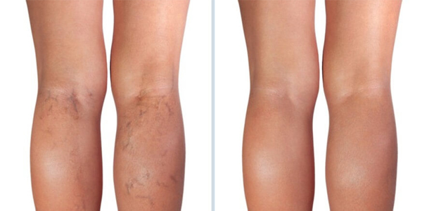 varicose veins laser treatment before and after