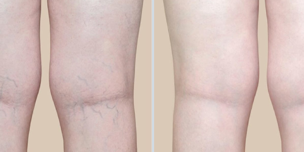 varicose veins laser treatment before and after
