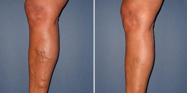 varicose veins laser treatment before and after