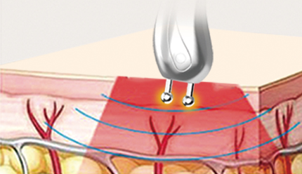 Bipolar RF Technology