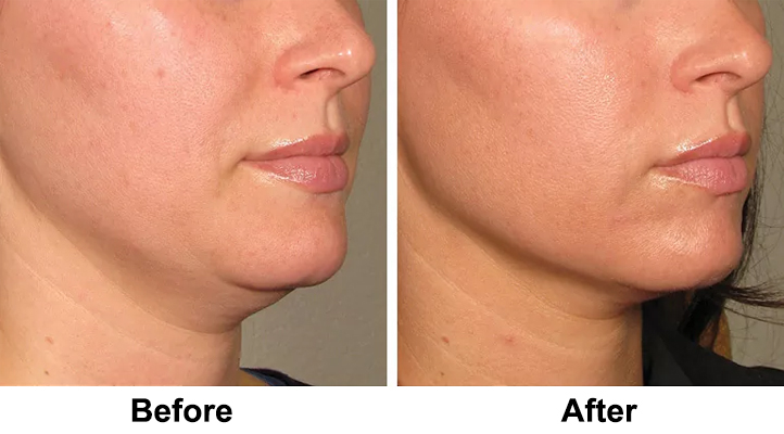 Face shaping before and after