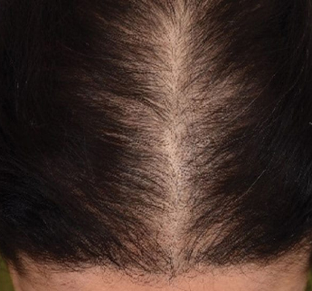 Red Light Therapy Before and After Hair Growth