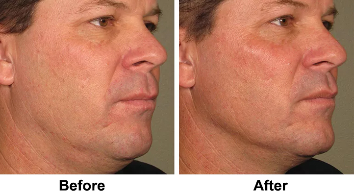 Wrinkle reduction before and after