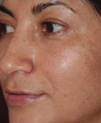 Skin Rejuvenation Before