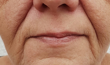 Face lifting Before