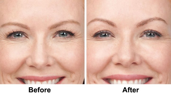 Facelift before and after