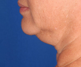 Double Chin Fat Freezing