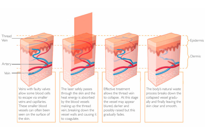 Vascular lesion removal