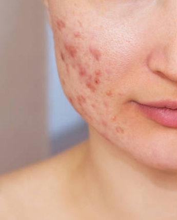 Acne, folliculitis, mite removal, removal of skin allergy sources