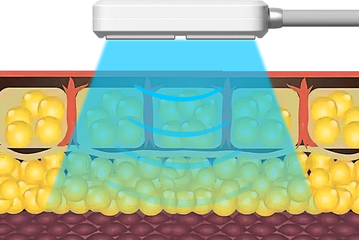 Fat Freezing - Cryolipolysis