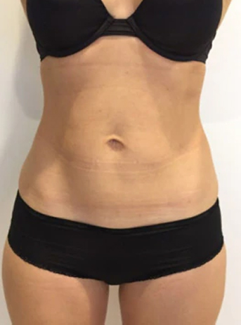 cryolipolysis treatment after