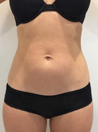 cryolipolysis treatment before