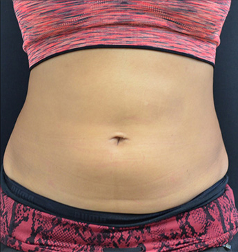 Non Surgical Abdomen sculpting Before and After