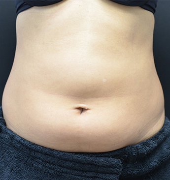 Non Surgical Abdomen sculpting Before and After