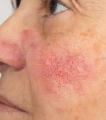 Spider Veins Treatment Before