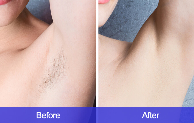 Armpit-Hair-Removal-before-and-after