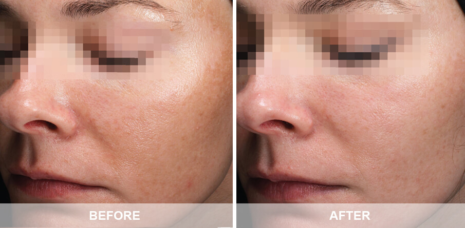 Before and after skin rejuvenation