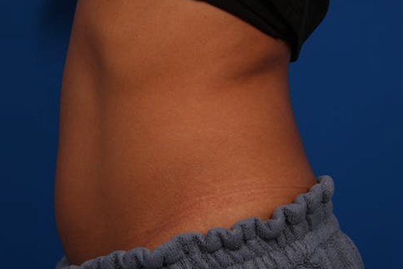 Coolsculpting Treatment Before