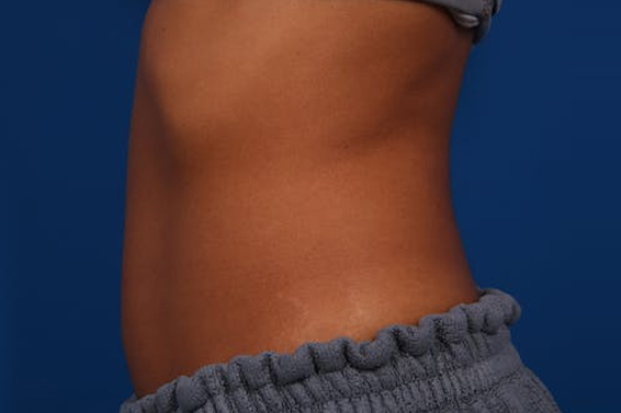 Coolsculpting Treatment after