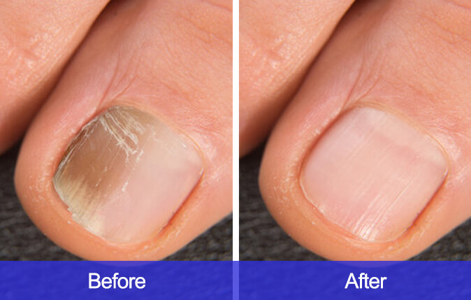 Cure-Ringworm-Of-the-Nails-before-and-after