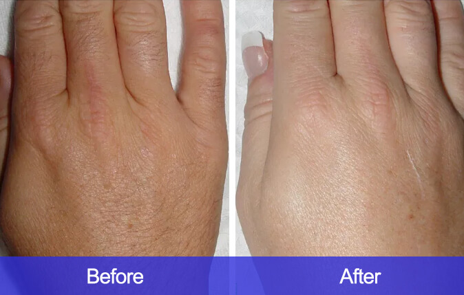 Hands-Hair-Removal-before-and-after