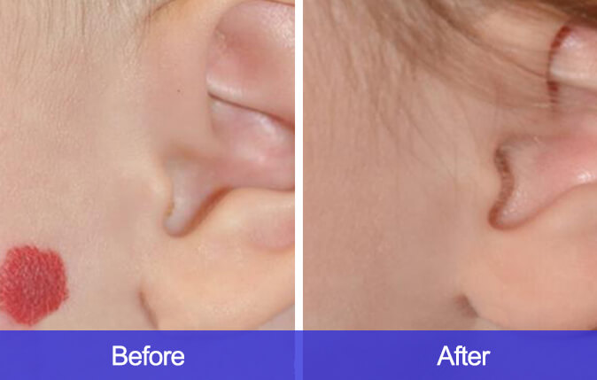 Hemangioma-Removal-before-and-after