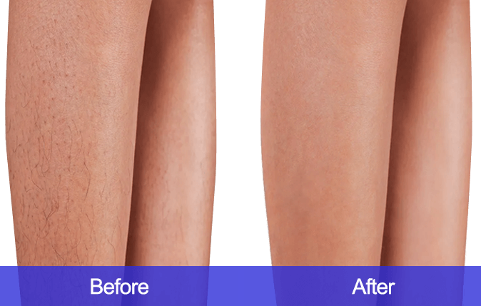 Leg-Hair-Removal-before-and-after