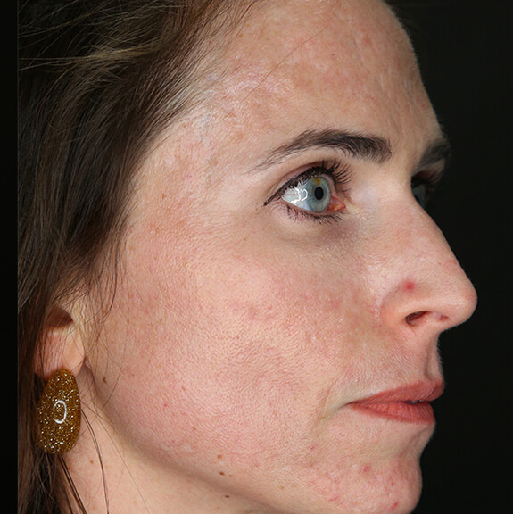 Plasma treatment Acne scar after