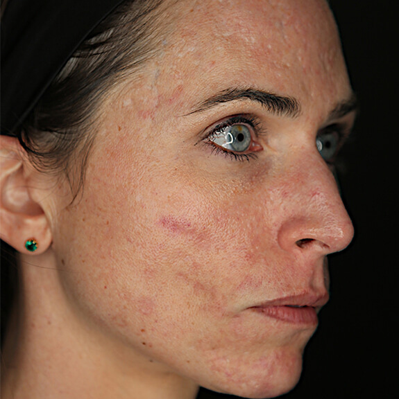 Plasma treatment Acne scar-before