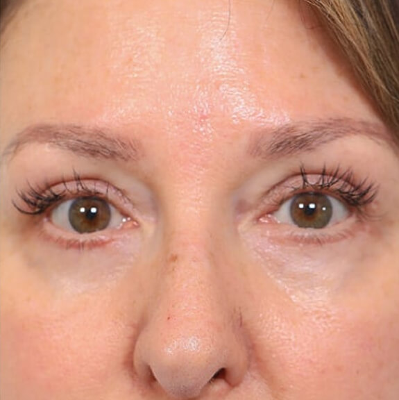 Plasma treatment Eyelid and eye bags after