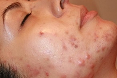 remove acne before