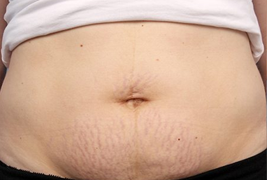 stretch marks treatment before