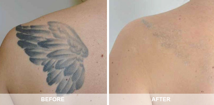 tattoo removal Before and after