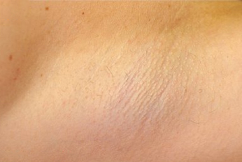 Underarm Laser Hair Removal after