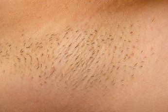 Underarm Laser Hair Removal before