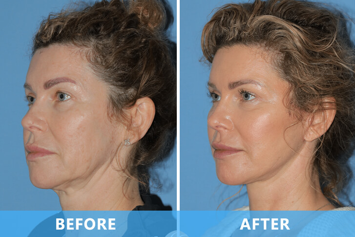 Vacuum face-lifting handle Treatment before & after