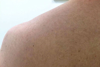 Body Laser Hair Removal after