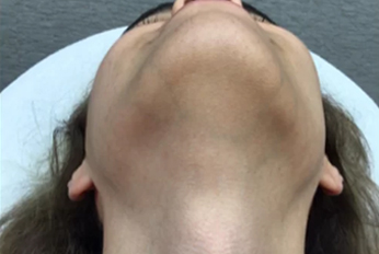 Under Chin Laser Hair Removal after