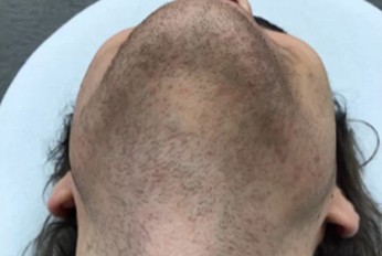 Under Chin Laser Hair Removal before