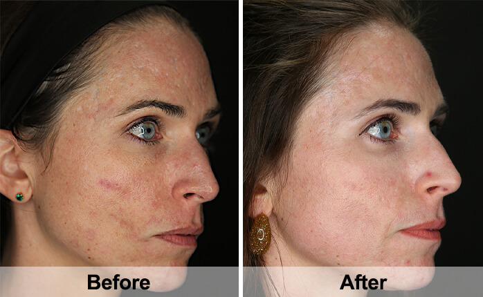 Acne Scar Treatment Before & After