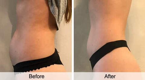 Cryolipolysis-before-after
