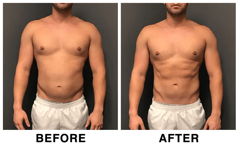 HIFEM-Treatment-Before-and-After-abdomen-1