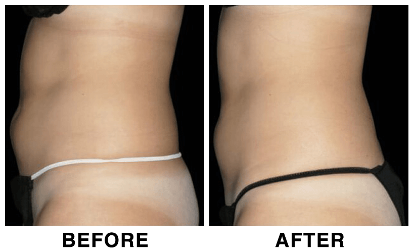 HIFEM-Treatment-Before-and-After-abdomen