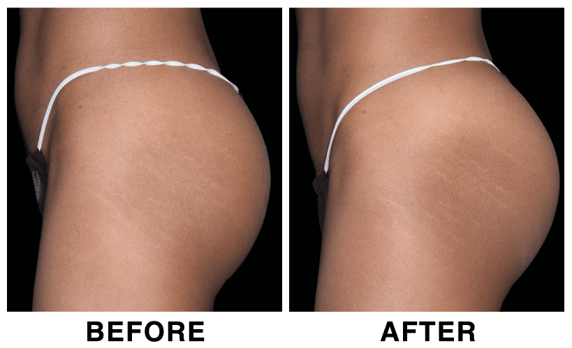 HIFEM-Treatment-Before-and-After-buttocks